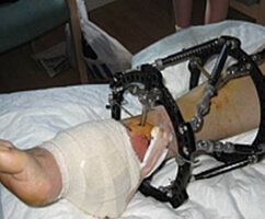 Amazing stem cell treatment saves Kent man’s leg