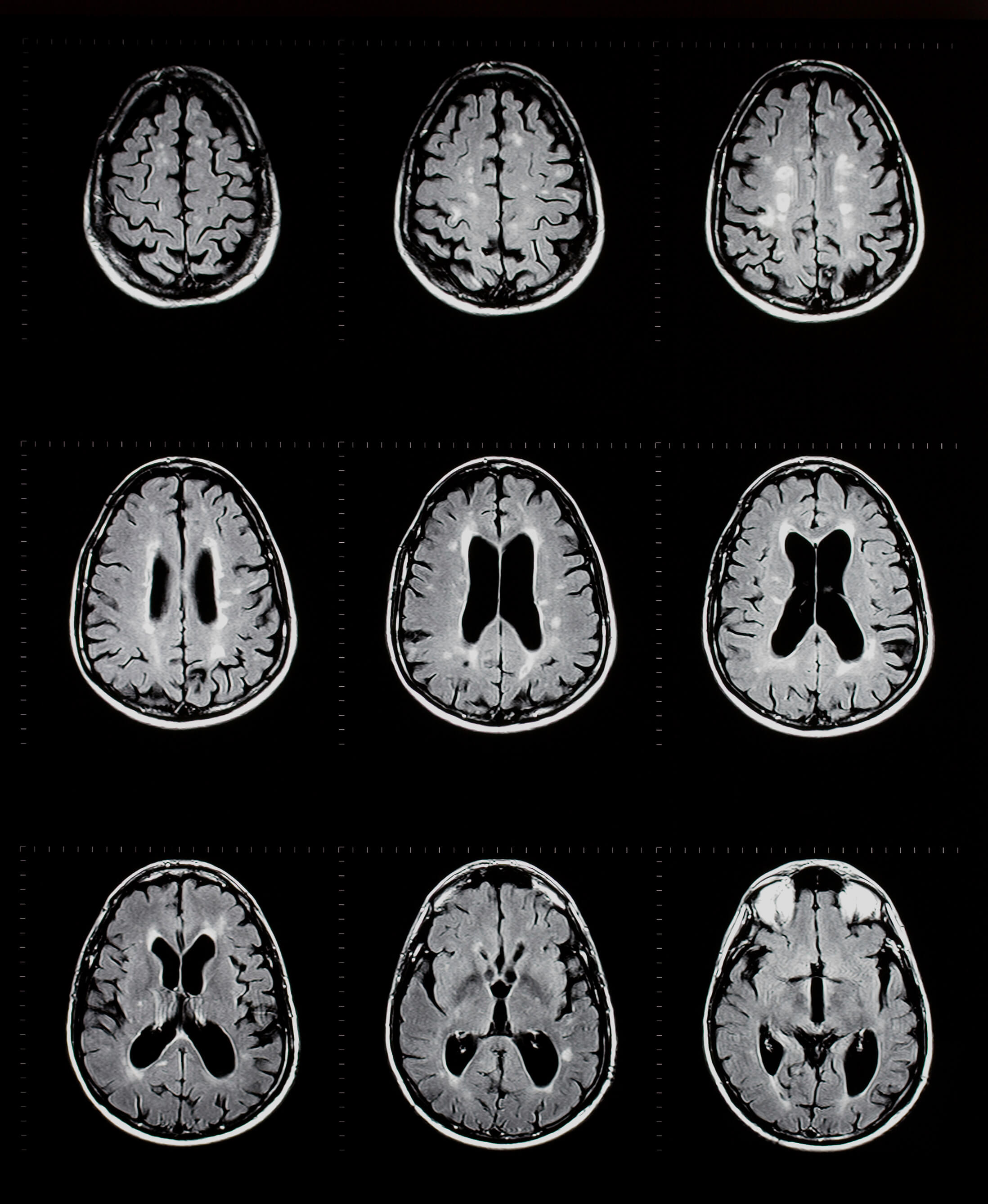 Brain Injury