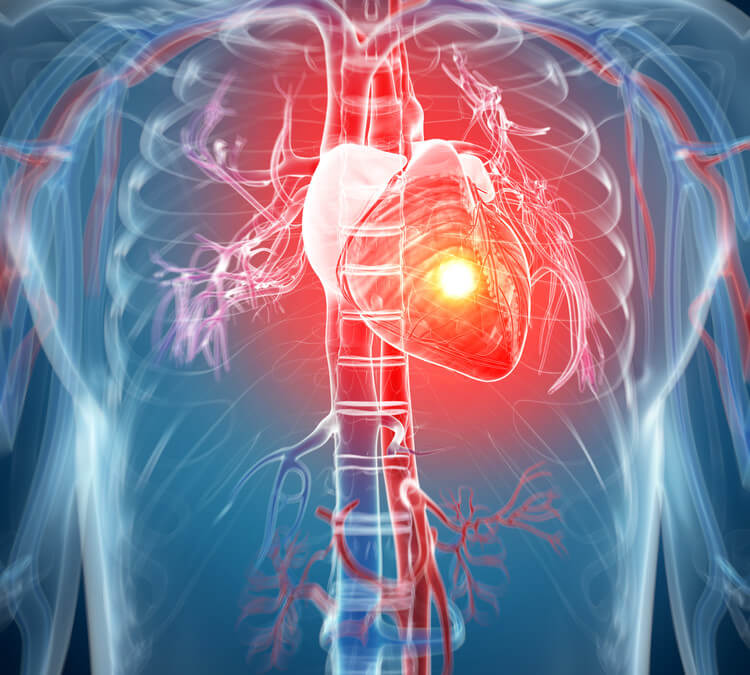 Heart Attack Angina Stem cells