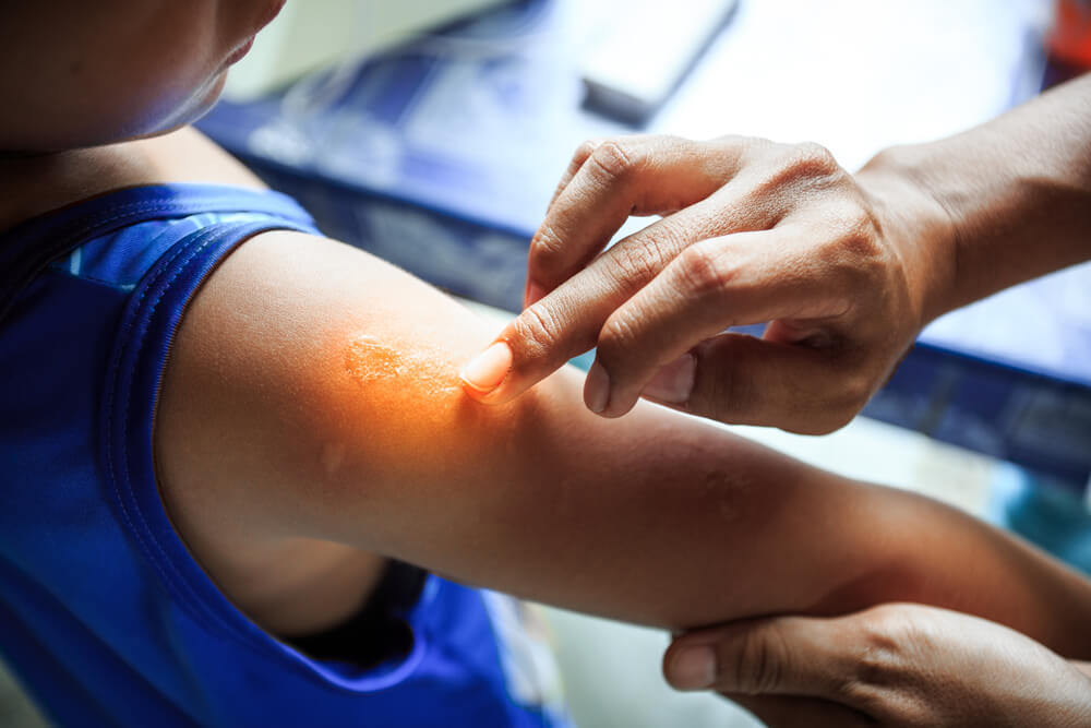 Stem cells used to treat eczema