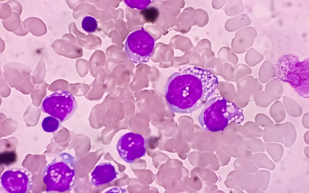 Leukemia Treatment Derived From Cord Blood Gains FDA Approval for Clinical Trials