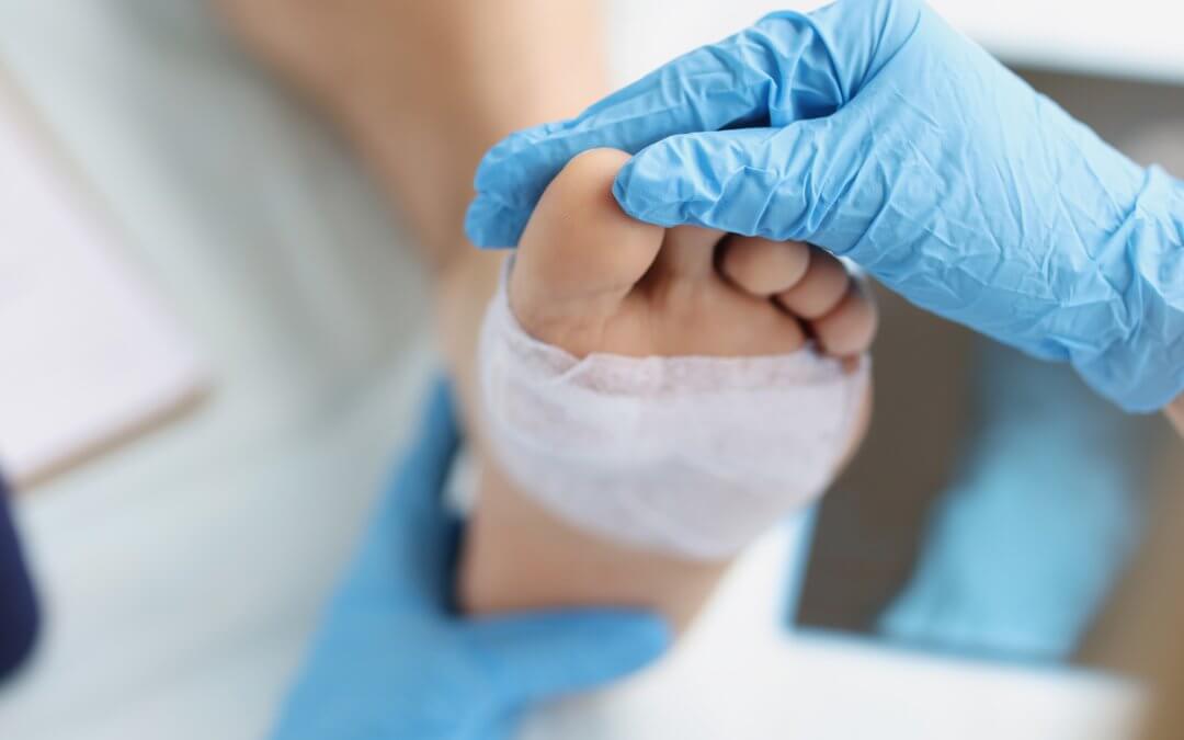 Can Stem Cell Therapy Heal Diabetic Foot Ulcers?