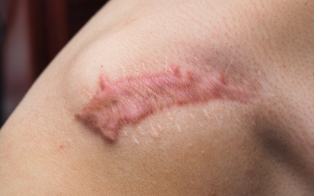 What Does Research Say About Stem Cells and Scarring?