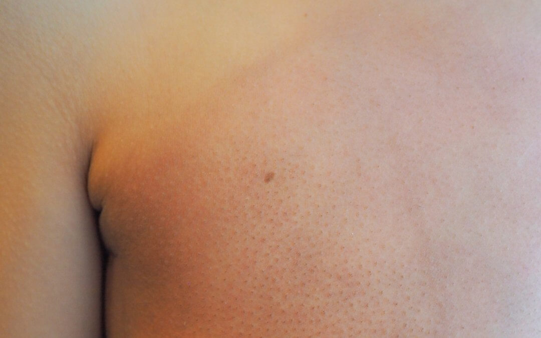 Clinical Trial Explores Placental Stem Cell Gel for Radiotherapy Skin Damage