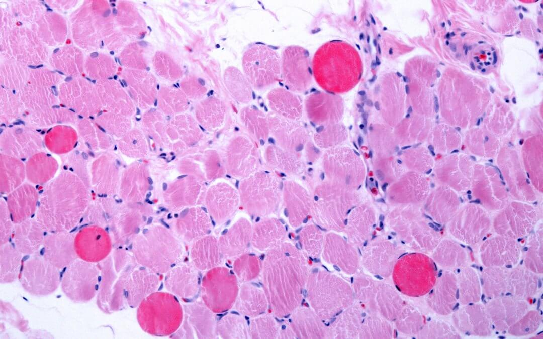Duchenne muscular dystrophy, muscle fibres