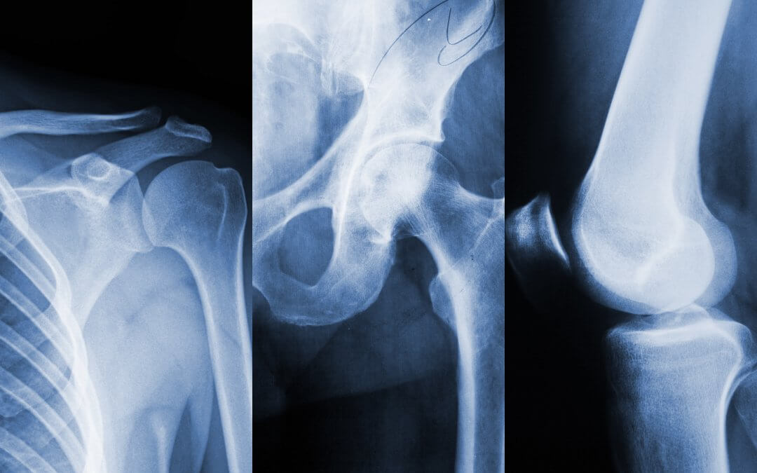 Shoulder, hip and knee joints x-ray illustration