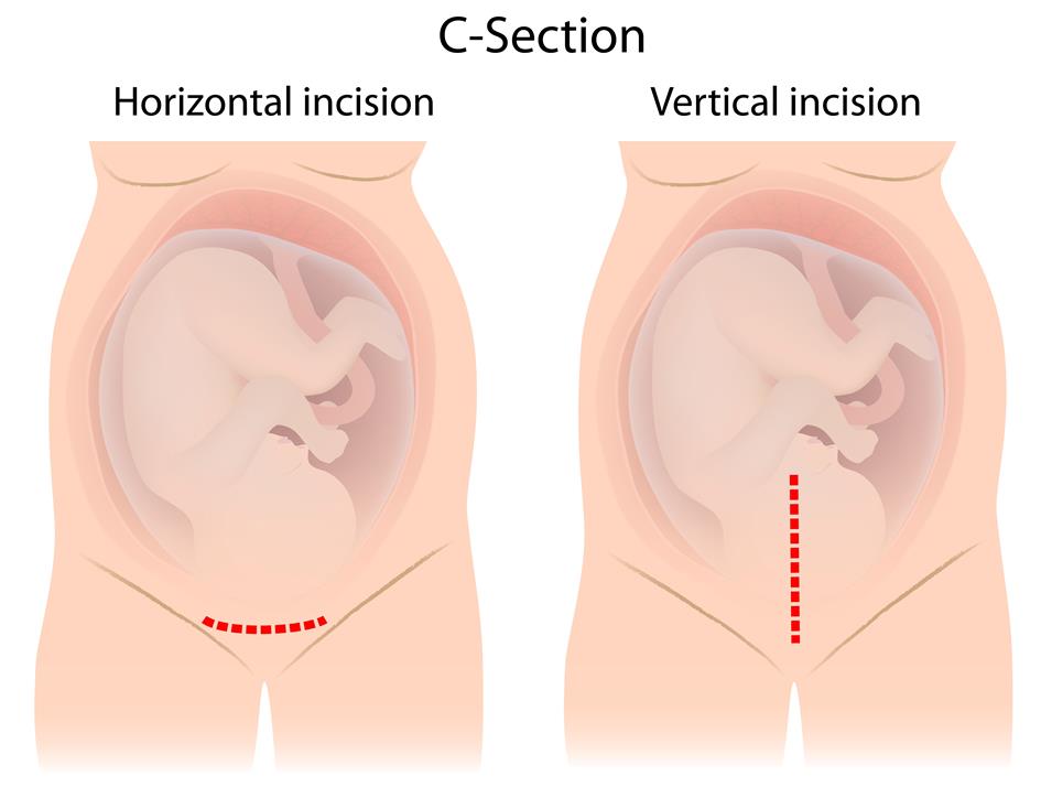 smaller_c_section_diagram.jpg smaller_c_section_diagram.jpg